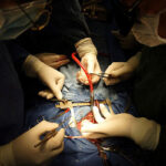 Медики провели в Симферополе уникальную операцию на открытом сердце